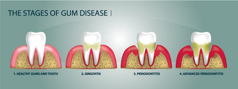 4-stages-of-gum-disease-fix-dentist-lewiston-auburn-maine-dental-office