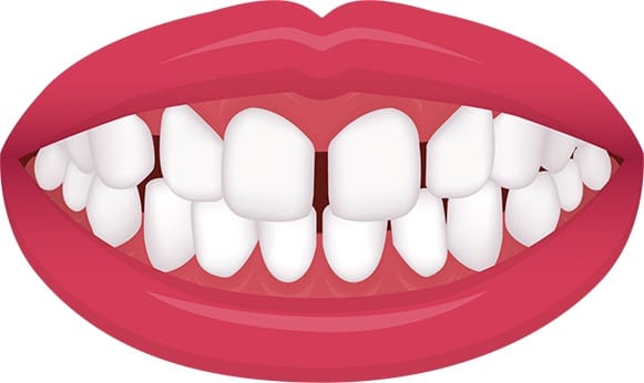 http://lewistonfamilydentist.com/wp-content/uploads/2020/08/EXCESSIVE-SPACING-teeth-INVISALIGN-INVISIBLE-BRACES-ALIGNERS-TRANSPARENT-LEWISTON-DENTIST-MAINE.jpg